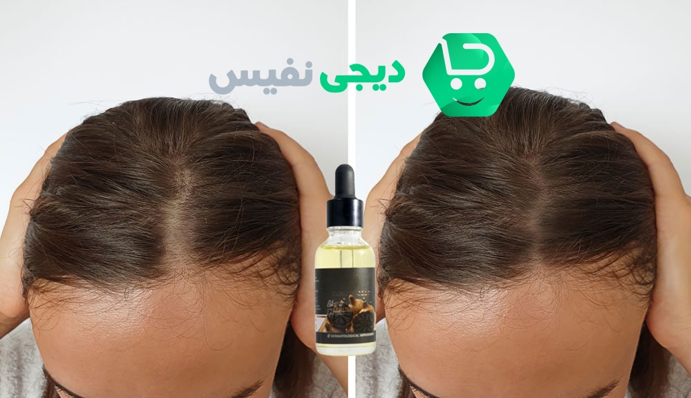 بهترین دارو برای ریزش مو