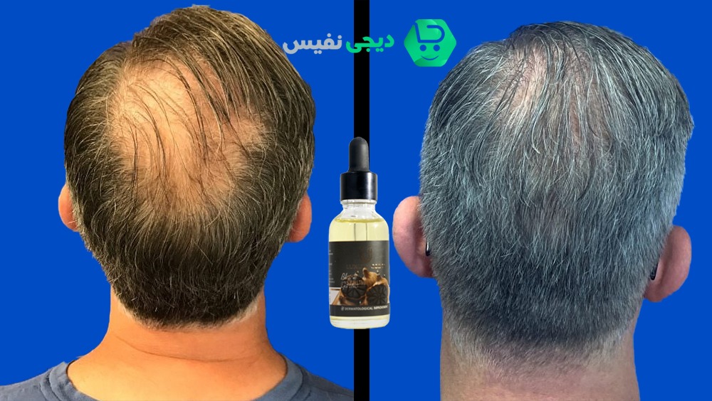 بهترین دارو برای ریزش مو چیست؟