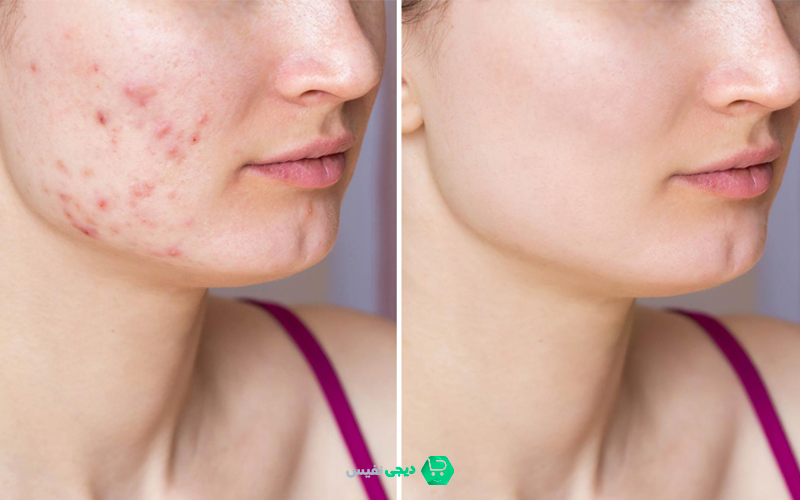 فواید کرم ژل آنتی آکنه گاتیو برای پوست چیست؟