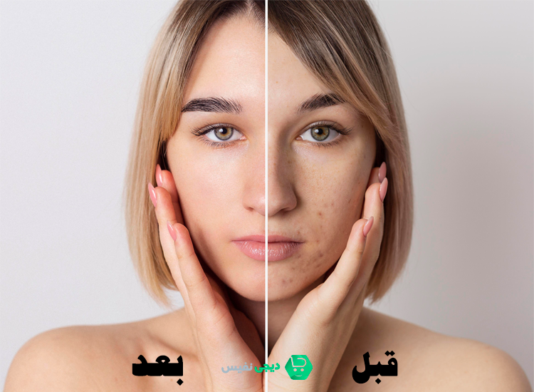 روش صحیح مصرف کرم ژل آنتی آکنه گاتیو برای تاثیر حداکثری