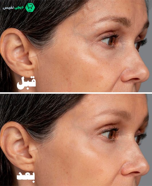 چرا آبرسان ژلی برای پوست خشک مناسب تر است؟