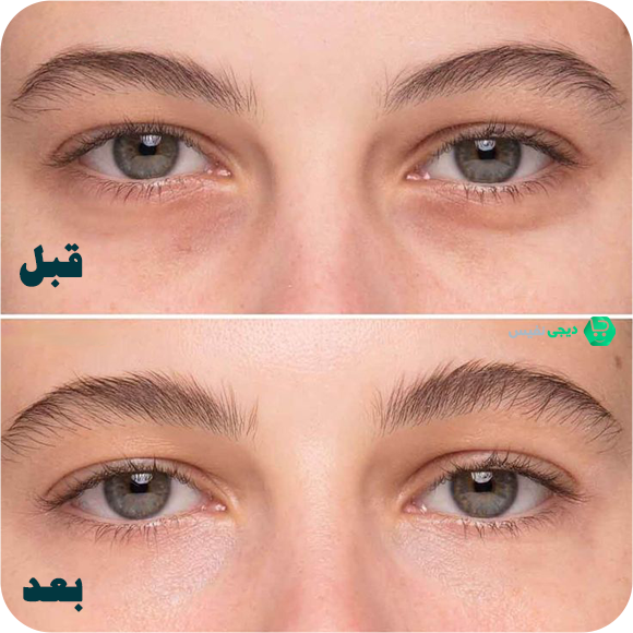 معرفی بهترین کرم دور چشم برای رفع تیرگی