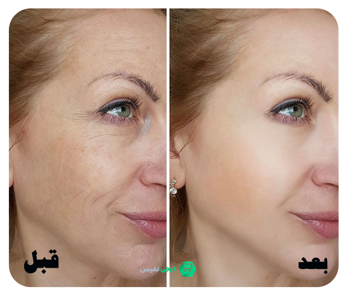 طرز استفاده کرم لیفتینگ صورت لاکچری کوین