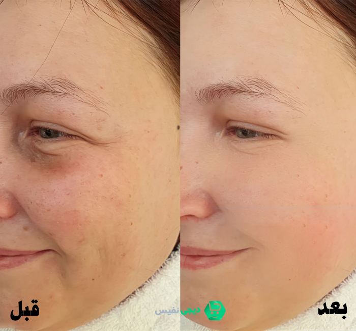 فواید سرم ویتامین C لاکچری کوین برای پوست